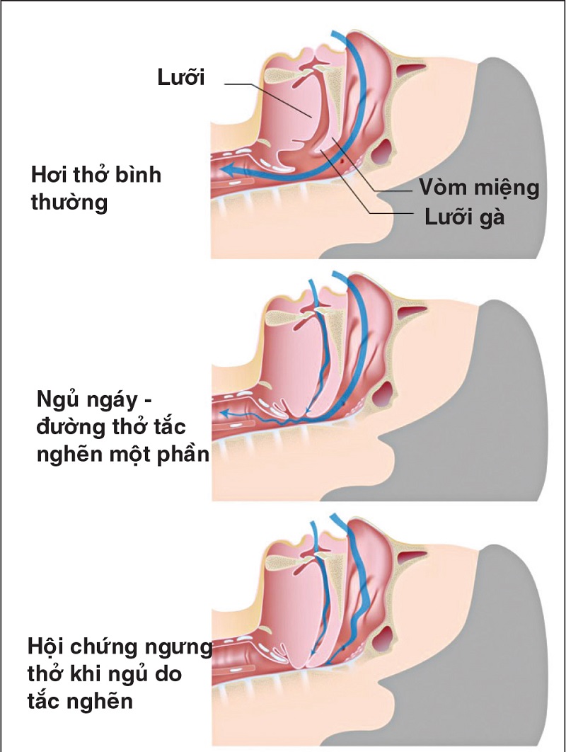 Nguyên nhân gây hội chứng ngưng thở khi ngủ